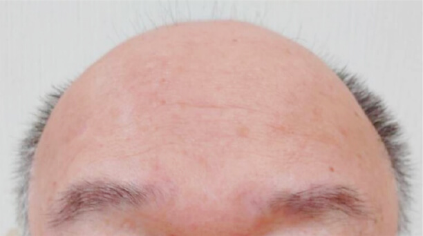 AGA 予防しなかった場合