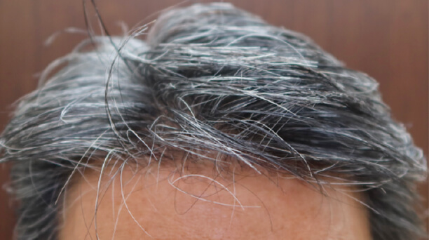 AGA 予防した場合