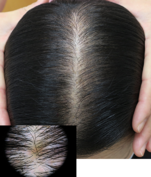 フラクショナルレーザー治療半年後