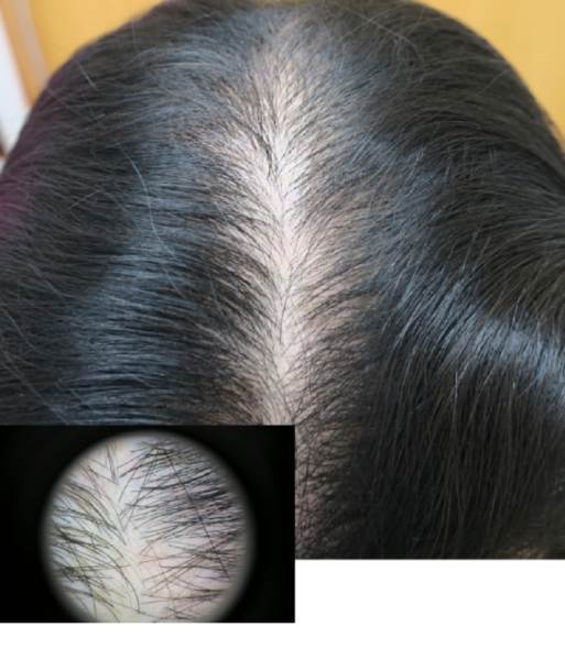 フラクショナルレーザー 治療前