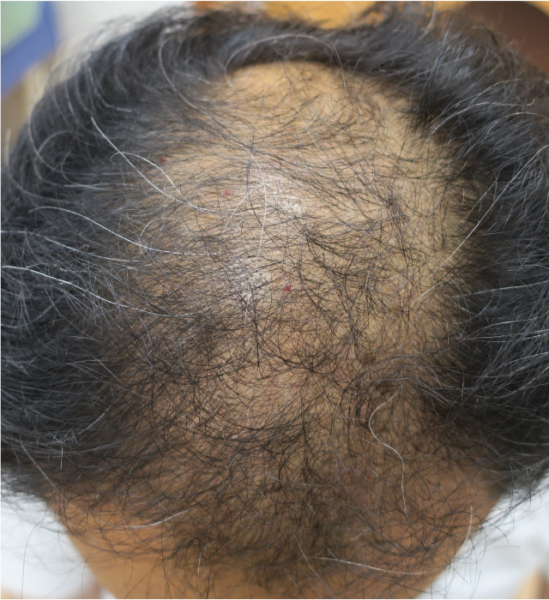 ミノキシジル外用のみ