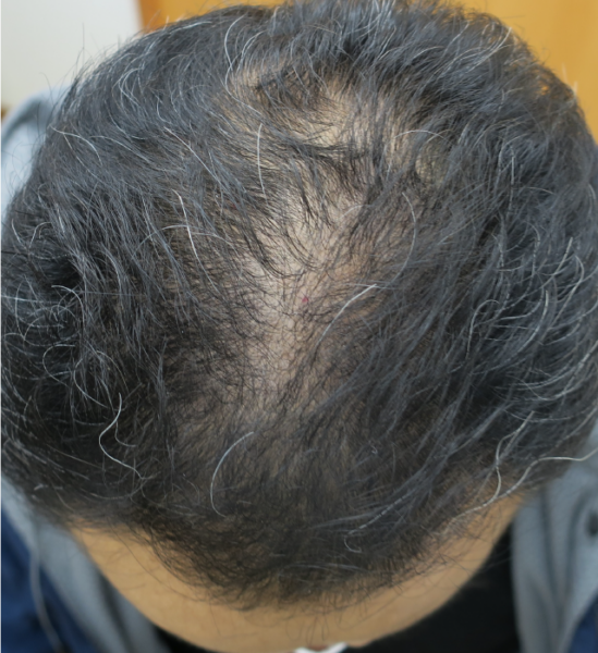 ミノキシジル外用+フィナステリド内服