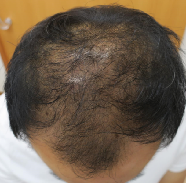 PRP再生医療半年後