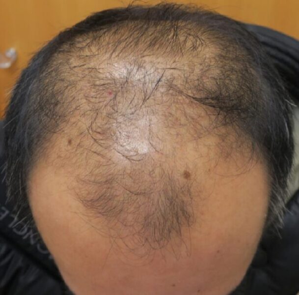 PRP再生医療治療前